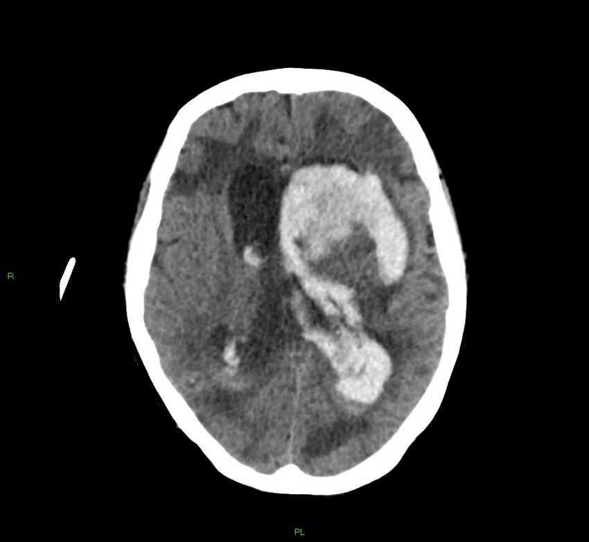 Basal ganglia hemorrhage (Radiopaedia 58766-65988 Axial non-contrast 30).jpg