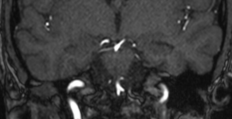File:Basilar artery fenestration (Radiopaedia 74537-85455 Coronal MRA TOF 44).jpg