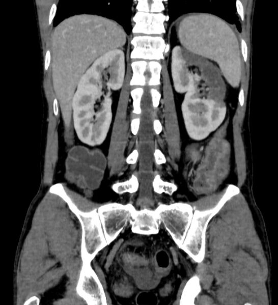 File:Behçet's disease- abdominal vasculitis (Radiopaedia 55955-62570 B 44).jpg