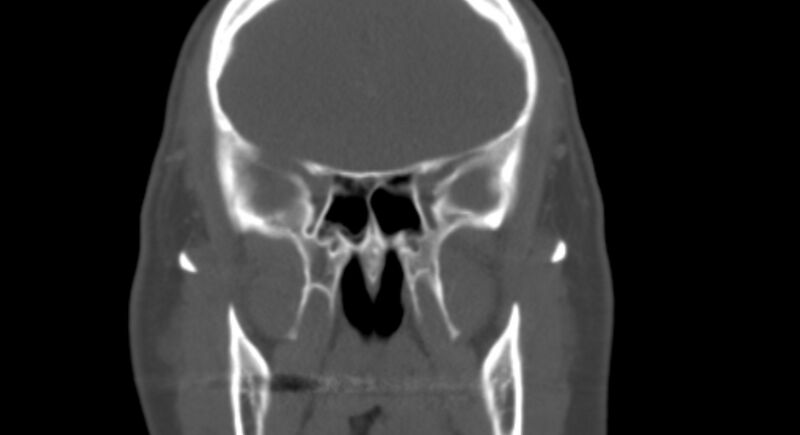 File:Benign mixed salivary tumor of the parotid gland (Radiopaedia 35261-36792 Coronal bone window 11).jpg