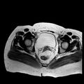 Benign seromucinous cystadenoma of the ovary (Radiopaedia 71065-81300 B 5).jpg