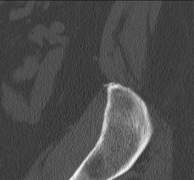 File:Bertolotti syndrome (Radiopaedia 24864-25128 Sagittal bone window 1).jpg