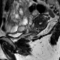 Bicornuate uterus (Radiopaedia 61974-70046 Sagittal T2 21).jpg