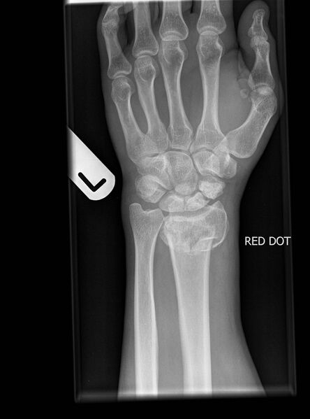 File:Bilateral distal radial fractures (Radiopaedia 10503-10976 Frontal 1).jpg
