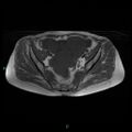 Bilateral ovarian fibroma (Radiopaedia 44568-48293 Axial T1 12).jpg