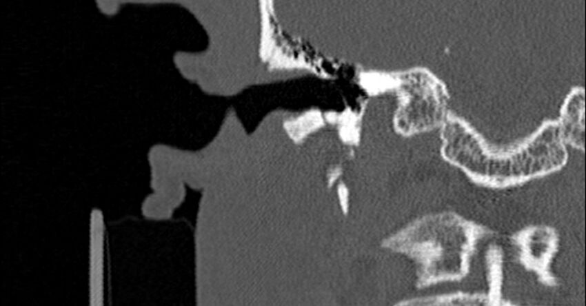 Bilateral temporal bone fractures (Radiopaedia 29482-29970 Coronal non-contrast 88).jpg