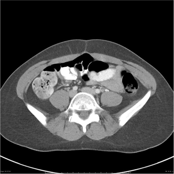 File:Bilateral ureteritis and cystitis (Radiopaedia 25340-25594 A 49).jpg