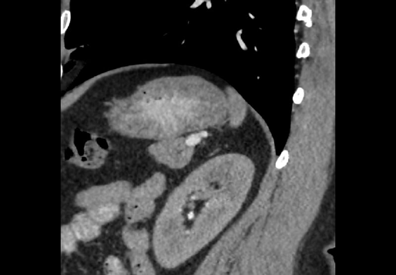 File:Bilateral urolithiasis with incidentally detected splenic artery aneurysm and left inferior vena cava (Radiopaedia 44467-48127 Ob. Sag. C+ Art. 14).jpg