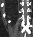 Bile leak from accessory duct(s) of Luschka post cholecystectomy (Radiopaedia 40736-43389 B 65).jpg