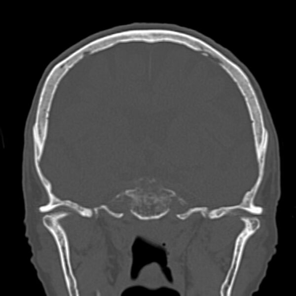 File:Biparietal osteodystrophy (Radiopaedia 46109-50463 Coronal bone window 52).jpg