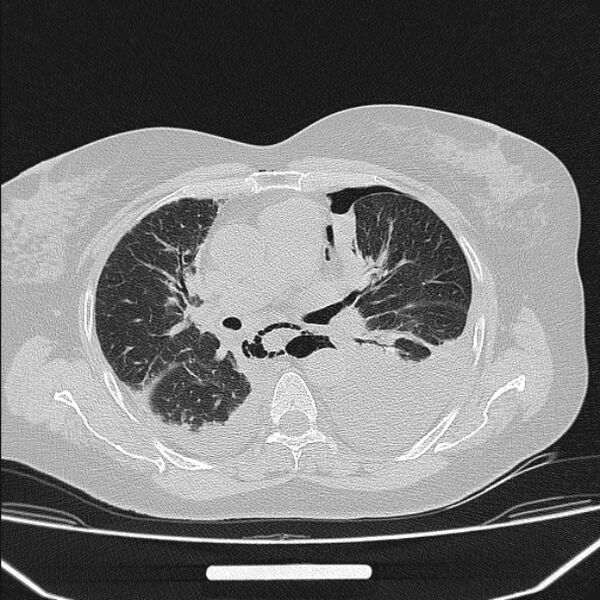 File:Boerhaave syndrome (Radiopaedia 45644-49799 Axial lung window 59).jpg
