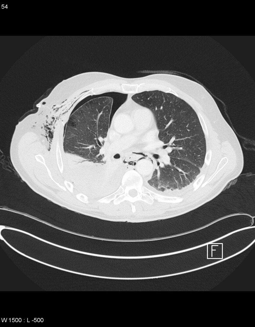 Boerhaave syndrome with tension pneumothorax (Radiopaedia 56794-63605 Axial lung window 26).jpg