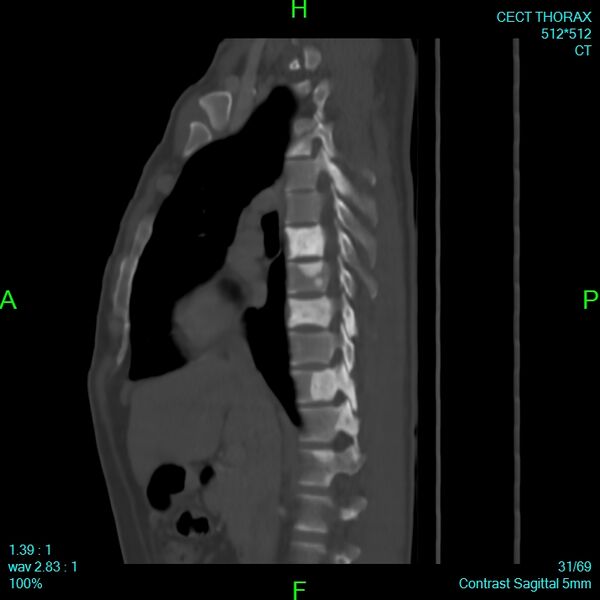 File:Bone metastases from lung carcinoma (Radiopaedia 54703-60937 Sagittal bone window 31).jpg