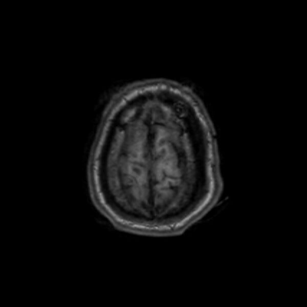 File:Brain abscess complicated by intraventricular rupture and ventriculitis (Radiopaedia 82434-96577 Axial T1 66).jpg