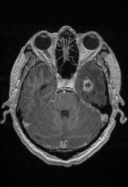 File:Brain abscess with ventriculitis (Radiopaedia 85703-101495 Axial T1 C+ 59).jpg
