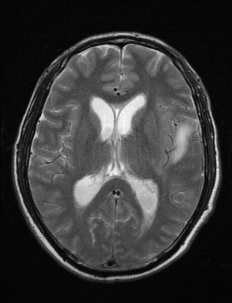 File:Brain abscess with ventriculitis (Radiopaedia 85703-101495 Axial T2 15).jpg