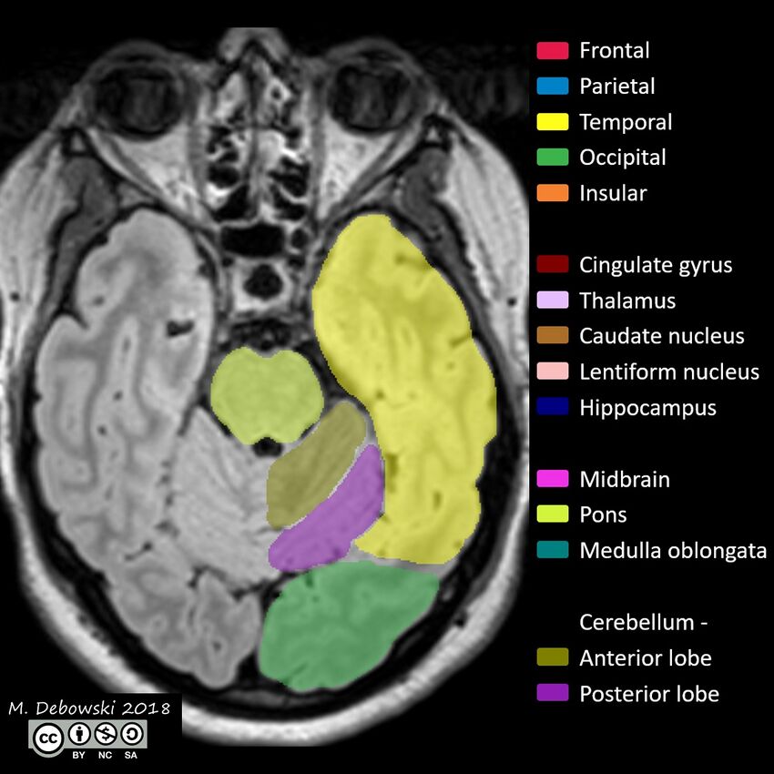 Brain lobes - annotated MRI (Radiopaedia 61691-69700 Axial 54).JPG