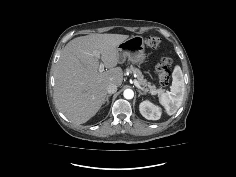 File:Brain metastases from renal cell carcinoma (Radiopaedia 42222-45328 A 12).jpg