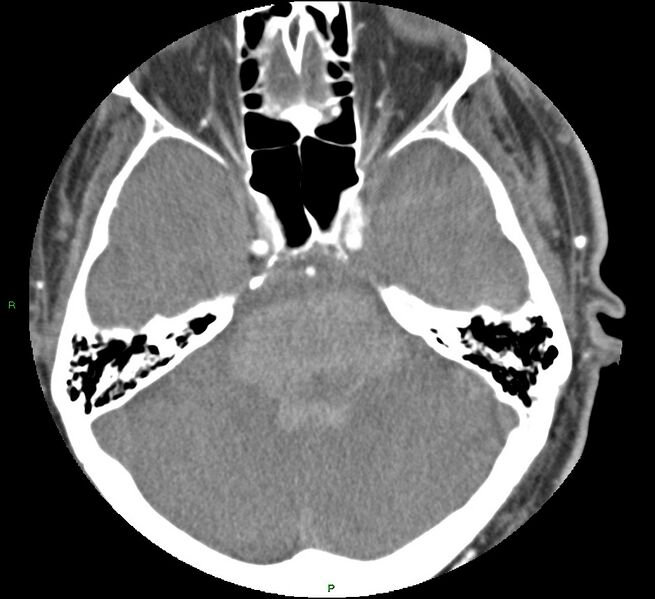 File:Brainstem hemorrhage (Radiopaedia 58794-66028 D 59).jpg