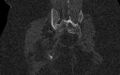 Breast carcinoma with pathological hip fracture (Radiopaedia 60314-67993 Coronal bone window 89).jpg