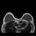Breast implants - MRI (Radiopaedia 26864-27035 Axial T1 21).jpg