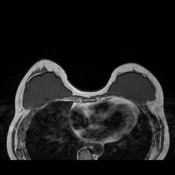 File:Breast implants - MRI (Radiopaedia 26864-27035 Axial T1 21).jpg