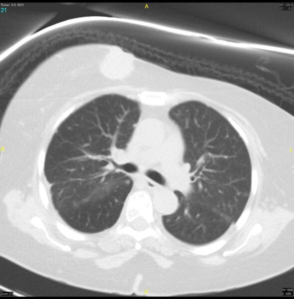 File:Breast primary with lung and bone metastases (Radiopaedia 40620-43228 Axial lung window 21).jpg