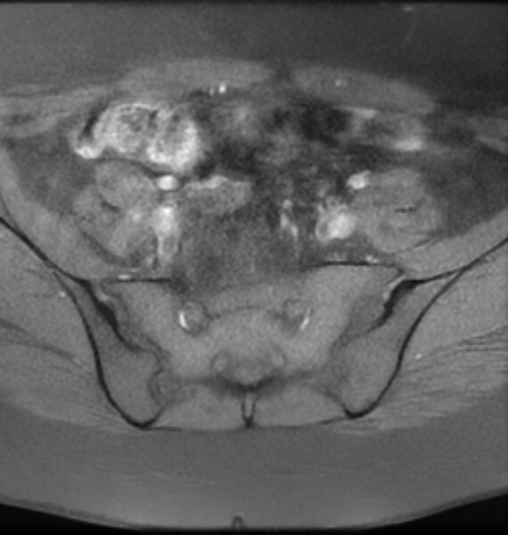File:Broad ligament leiomyoma (Radiopaedia 81634-95516 Axial T1 fat sat 3).jpg