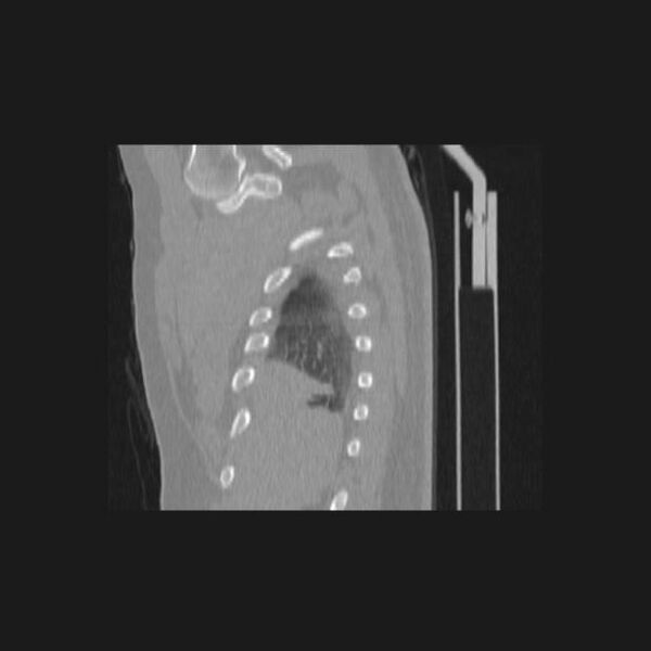 File:Bronchial atresia (Radiopaedia 60685-68439 Sagittal lung window 5).jpg