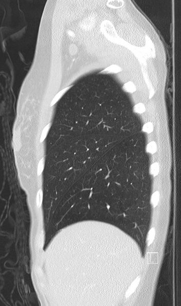 File:Bronchial atresia (Radiopaedia 73677-84470 Sagittal lung window 8).jpg