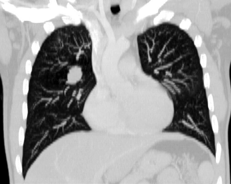 File:Bronchocele (Radiopaedia 12104-12460 Coronal lung window 7).jpg