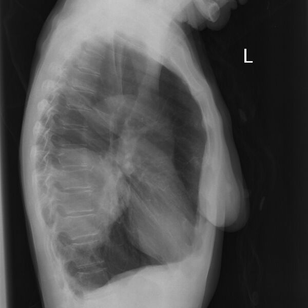 File:Bronchogenic carcinoma mimicking a breast implant (Radiopaedia 10561-11027 B 1).jpg