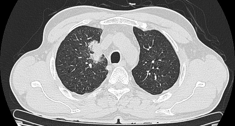File:Bronchogenic carcinoma with superior vena cava syndrome (Radiopaedia 36497-38054 Axial lung window 28).jpg