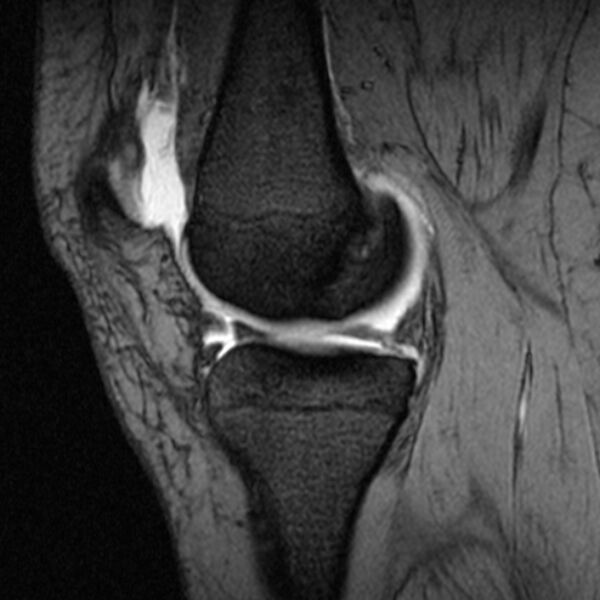 File:Bucket handle tear - medial meniscus (Radiopaedia 79028-91942 D 16).jpg