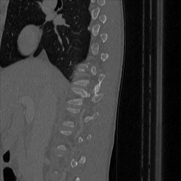 File:Bulging of paraspinal line in traumatic thoracal spinal compression fracture (Radiopaedia 29221-35872 Sagittal bone window 4).jpg