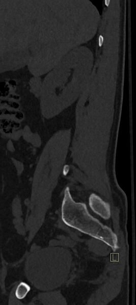 File:Calcaneal fractures with associated L2 burst fracture (Radiopaedia 71671-82493 Sagittal bone window 75).jpg