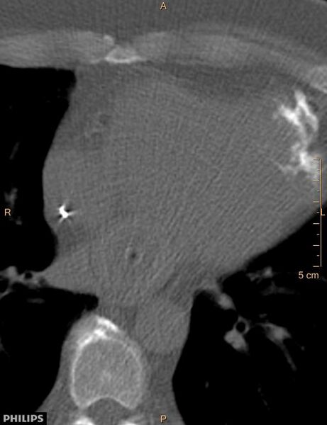 File:Calcified cardiac fibroma (Radiopaedia 39267-41519 Axial bone window 13).jpg