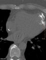 Calcified cardiac fibroma (Radiopaedia 39267-41519 Axial bone window 13).jpg