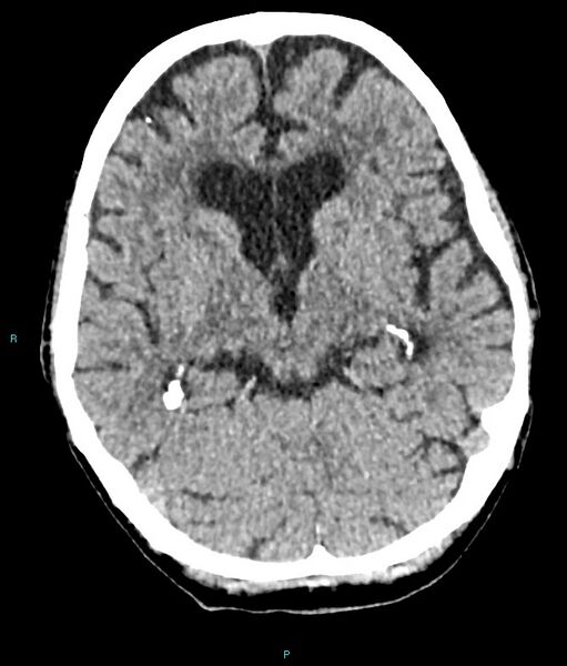 File:Calcified cerebral emboli from left ventricular thrombus (Radiopaedia 84420-99758 Axial non-contrast 56).jpg