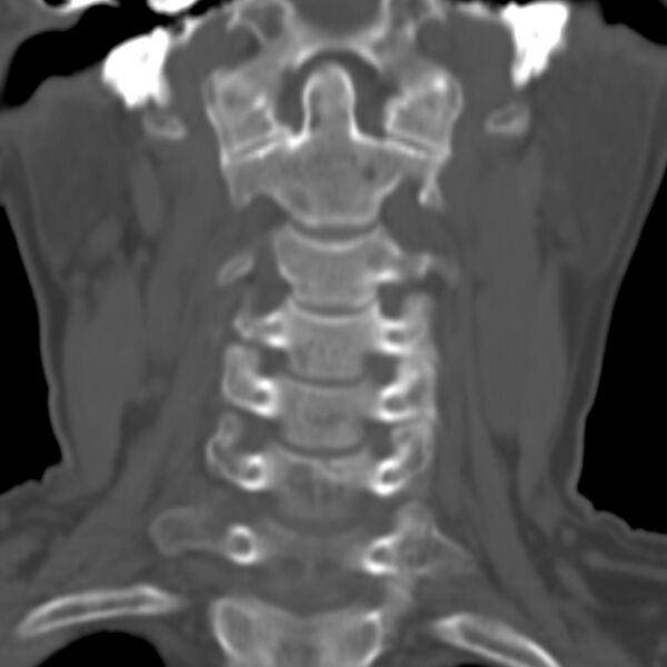 File:Calcified meningioma - cervical canal (Radiopaedia 70136-80171 Coronal bone window 6).jpg