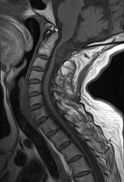 File:Calcified meningioma - cervical canal (Radiopaedia 70136-82468 Sagittal T1 7).jpg