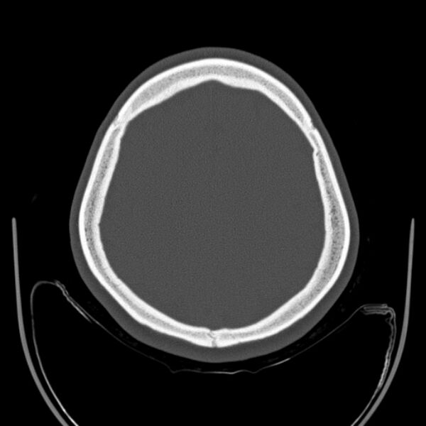 File:Calvarial osteoma (Radiopaedia 36520-38079 Axial bone window 83).jpg