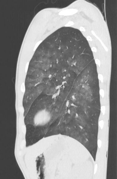 File:Cannabis-induced diffuse alveolar hemorrhage (Radiopaedia 89834-106946 Sagittal lung window 108).jpg