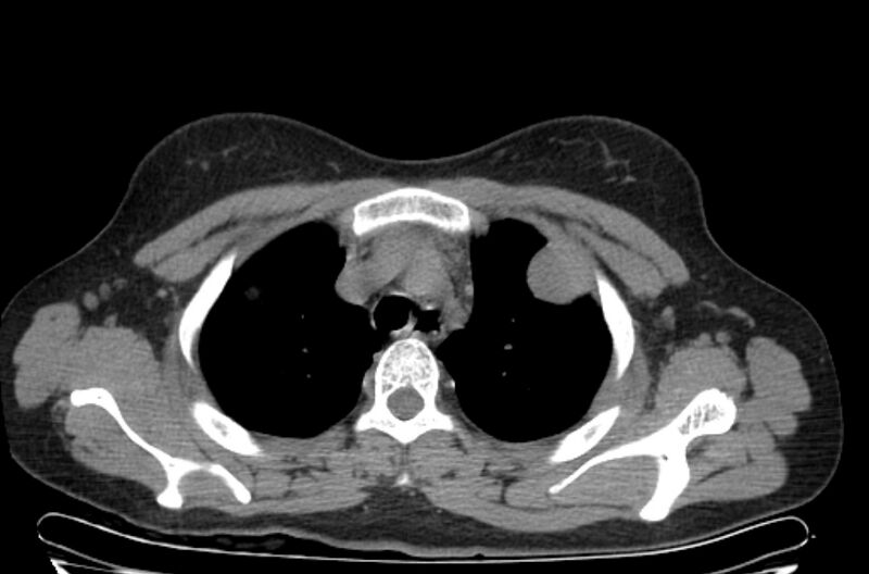 File:Cannonball metastases - uterine choriocarcinoma (Radiopaedia 70137-80173 Axial non-contrast 17).jpg