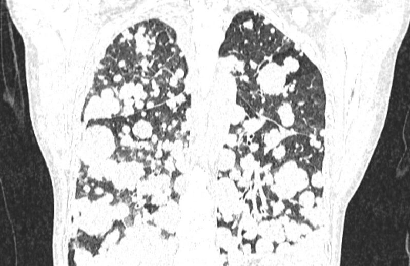 File:Cannonball metastases from breast cancer (Radiopaedia 91024-108569 Coronal lung window 101).jpg