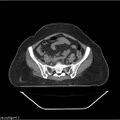 Carcinoma cervix- brachytherapy applicator (Radiopaedia 33135-34173 Axial non-contrast 10).jpg