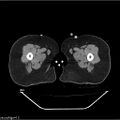 Carcinoma cervix- brachytherapy applicator (Radiopaedia 33135-34173 Axial non-contrast 72).jpg