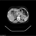 Carcinoma cervix- recurrence (Radiopaedia 34702-36137 B 15).jpg