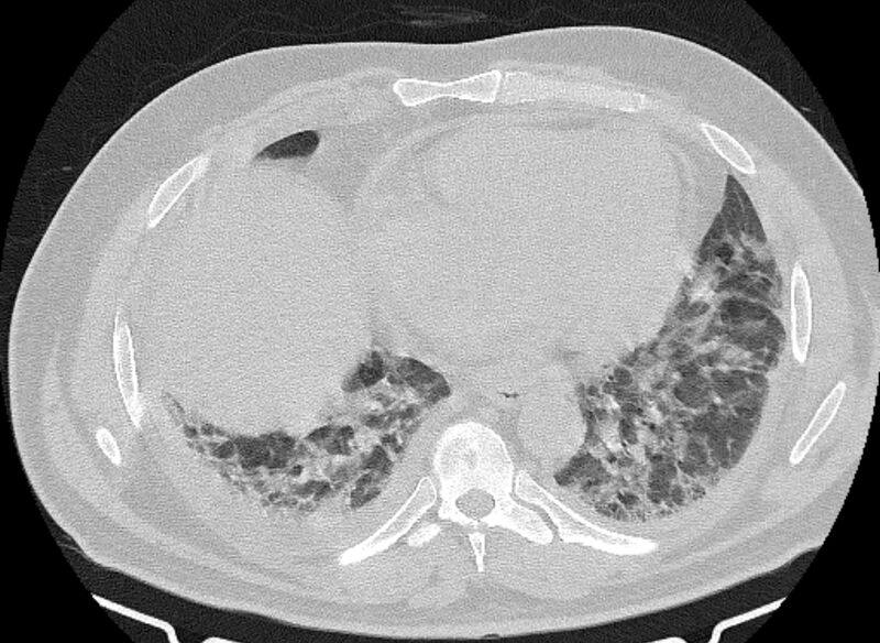 File:Cardiogenic pulmonary edema (Radiopaedia 68180-77678 Axial lung window 68).jpg