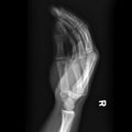 Carpometacarpal fracture dislocation (Radiopaedia 12674-12852 Lateral 1).jpg